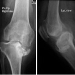Rx in proiezione antero-posteriore e laterale del ginocchio destro. Esiti di frattura complessa dell'emipiatto tibiale mediale con deviazione in varismo (circa 20°) dell'asse femoro-tibiale