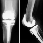 Controllo radiografico a 6 anni dall'intervento, con buon allineamento della protesi e completa incorporazione dell'innesto all'osso ospite