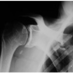 Rx pre-operatorio: in evidenza il quadro di osteoartrosi G/O con corpi mobili articolari