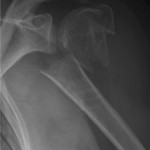 La radiografia eseguita in Pronto Soccorso evidenzia una frattura a 4 frammenti