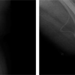 Rx in proiezione antero-posteriore e latero-laterale del ginocchio sinistro. Postumi di posizionamento di artroprotesi, Rx postintervento (26.05.2011). Buon allineamento della protesi