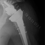 Il controllo radiografico finale mostra il corretto posizionamento delle componenti protesiche