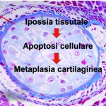 Tra i fattori coinvolti nell'eziopatogenesi delle tendinopatie calcifiche, concorre l'ipossia tissutale, responsabile di un progressivo processo apoptotico, che causa il deposito di sali di calcio nella matrice extracellulare