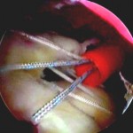 Riparazione artroscopica con tecnica single row