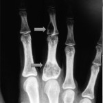 La radiografia della mano sinistra mostra due lesioni osteolitiche, circondate da distruzione corticale a livello delle falangi prossimale e media del terzo dito